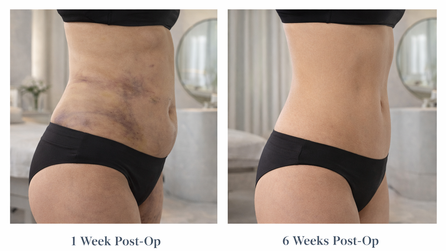 Body contouring results over time